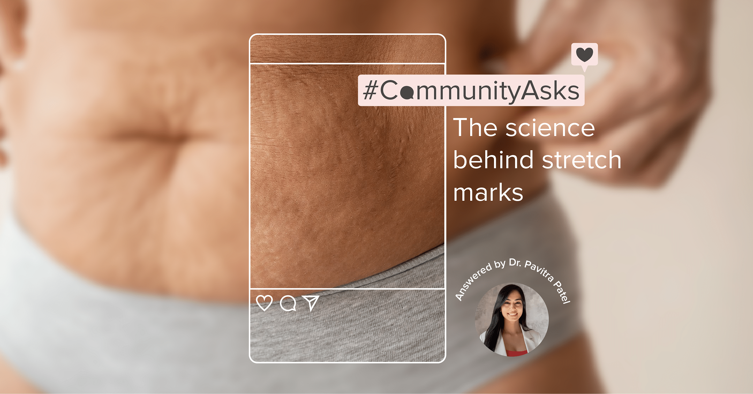 Community Asks: The science behind stretch marks