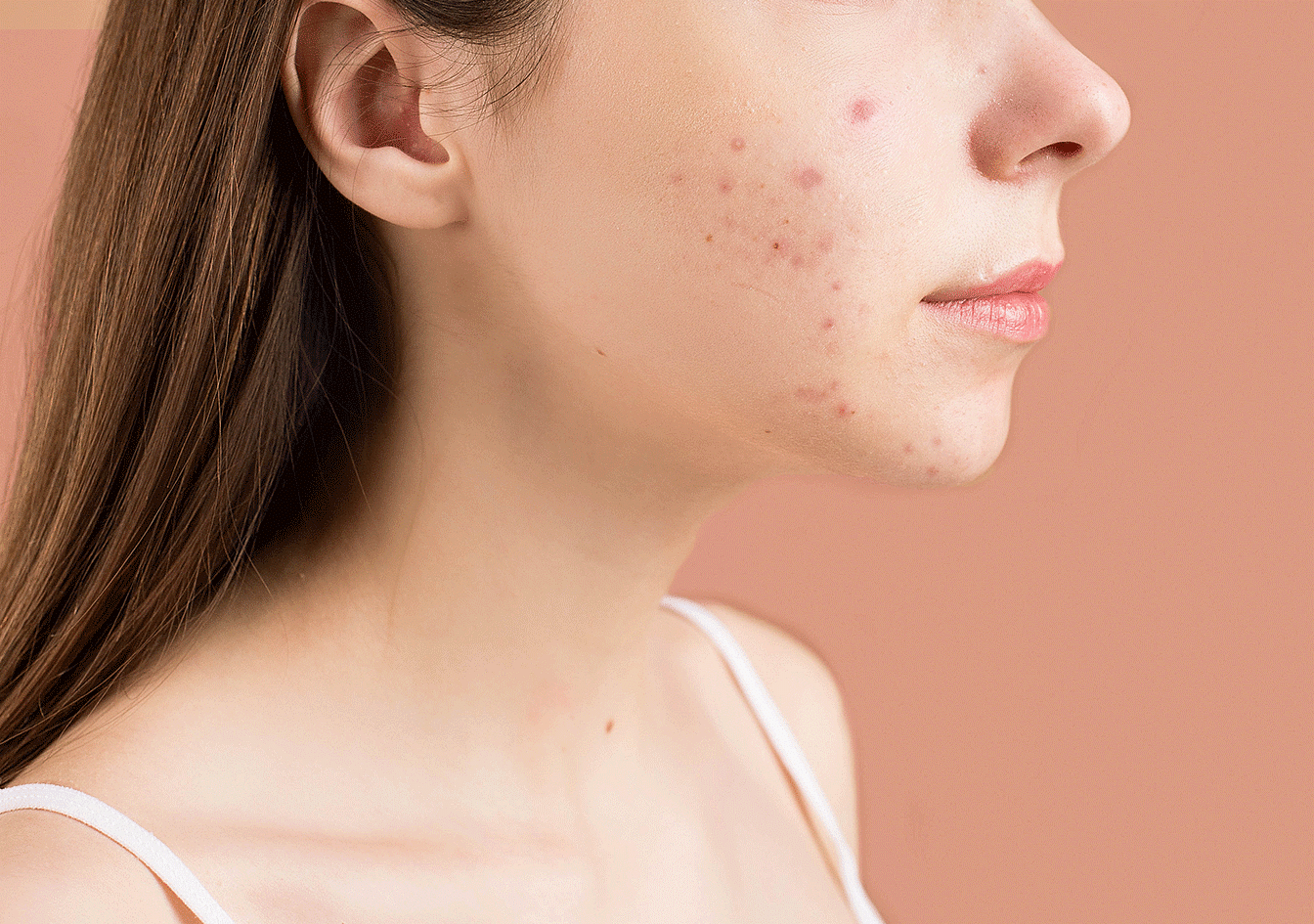 Types of acne & when to start worrying