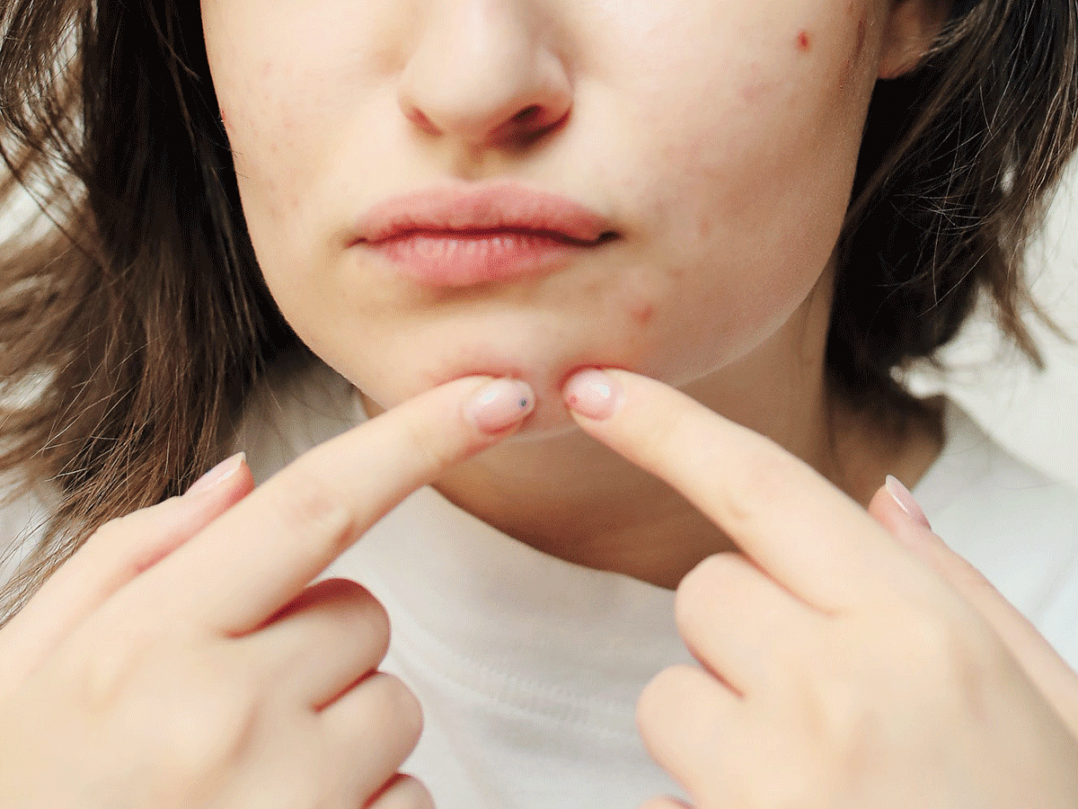 Causes of acne 6